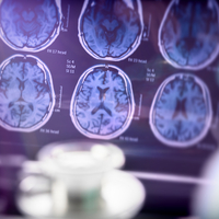 Beyin hücrelerinde "mikroplastik" tespit edildi