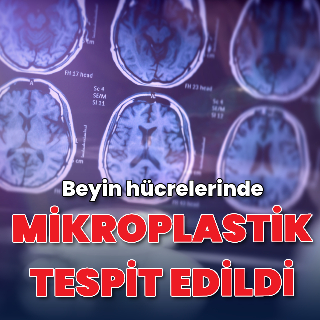 Beyin hücrelerinde "mikroplastik" tespit edildi
