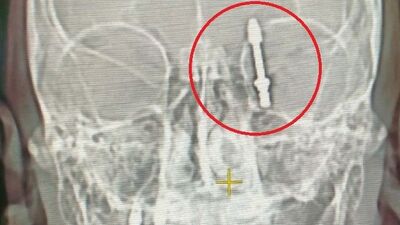 Diş implantı omurilik sıvısına girdi! Şimdi hukuk mücadelesi veriyor