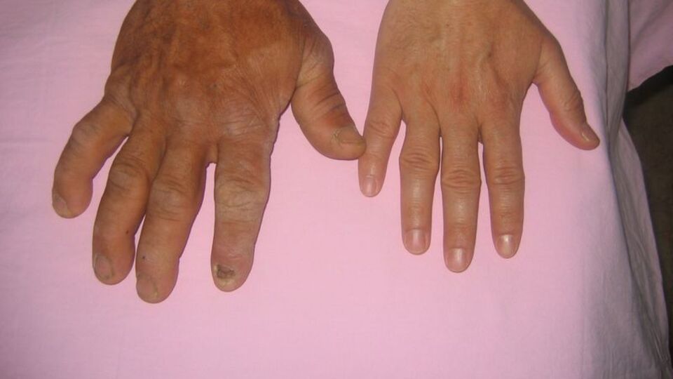 Geç fark ediliyor! Tanısı 5-10 yıl gecikiyor