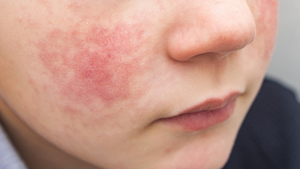 Beşinci hastalığa dikkat!