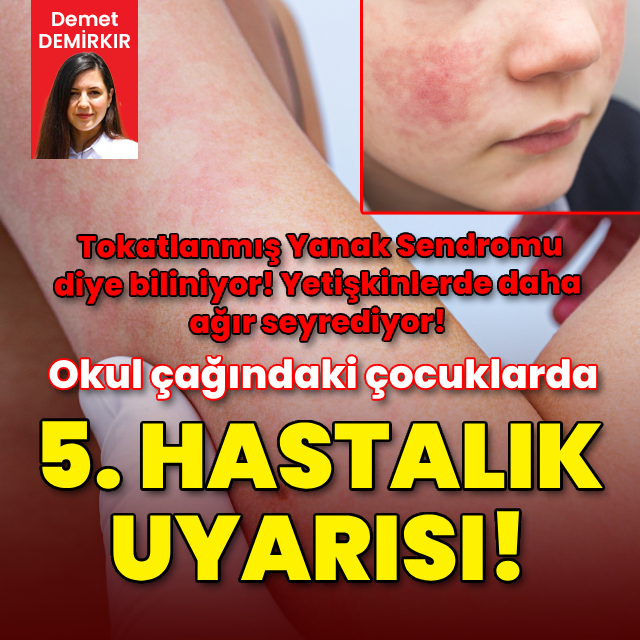 Beşinci hastalığa dikkat!