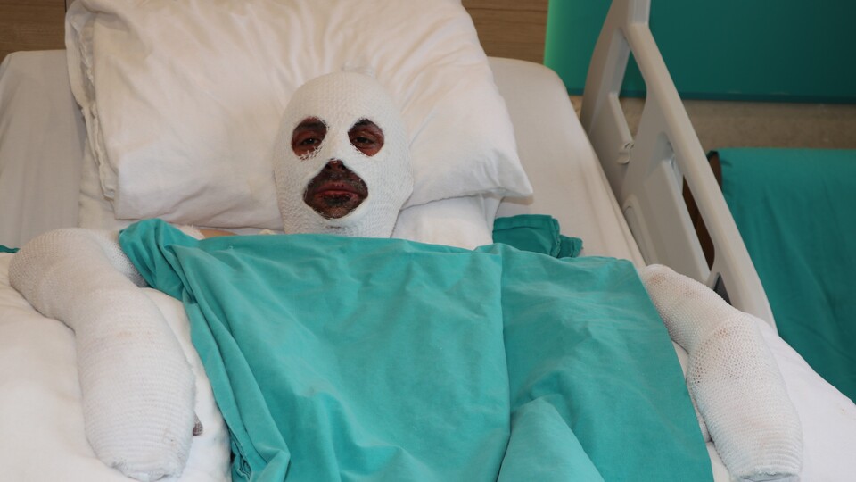 Gazı açıp sohbete dalan döner ustası hastanelik oldu