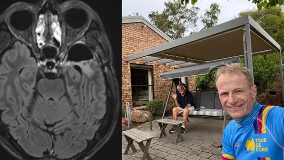 Avustralyalı doktor, beyin kanserini kendi çalışmasıyla tedavi etti