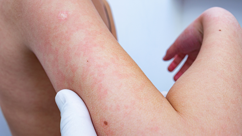 Kurdeşen kronikleştiğinde intihar riskine dahi yol açabilir