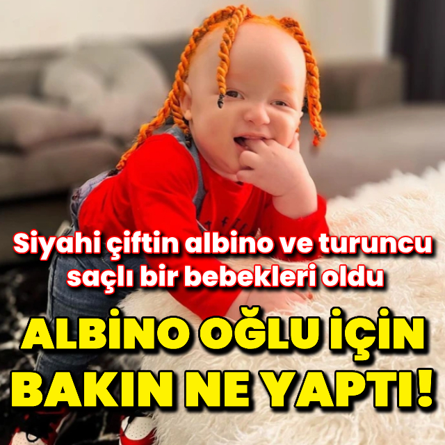 Albino oğlu için bakın ne yaptı!