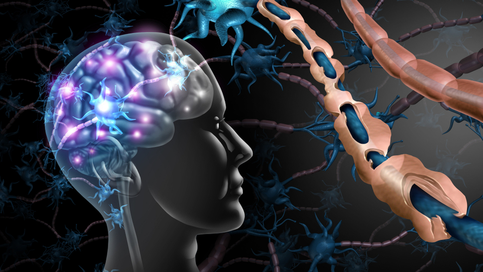 Dikkat bu şikayetler MS belirtisi olabilir!