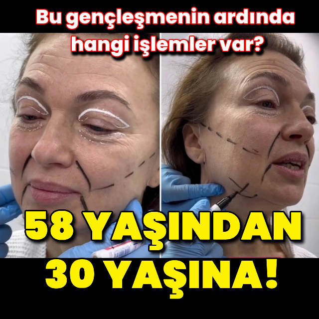 58 yaşındaki kadın 30 yaş görünümüne kavuştu!
