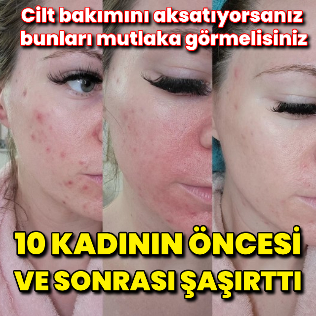 Düzenli cilt bakımının öncesi sonrası kareleri!