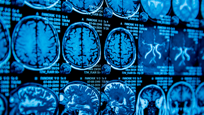 Genç yaşta Parkinson vakaları artıyor!