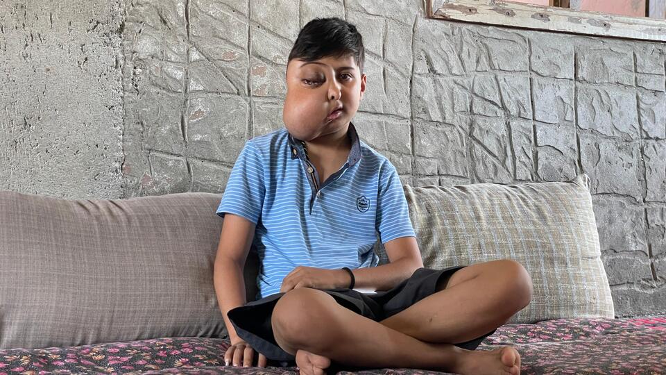 Yüzündeki kitle her geçen gün büyüyen ve gözünü kaybeden Enes, sağlığına kavuşmak istiyor