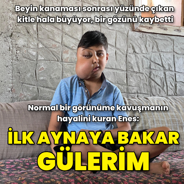 Yüzündeki kitle her geçen gün büyüyen ve gözünü kaybeden Enes, sağlığına kavuşmak istiyor