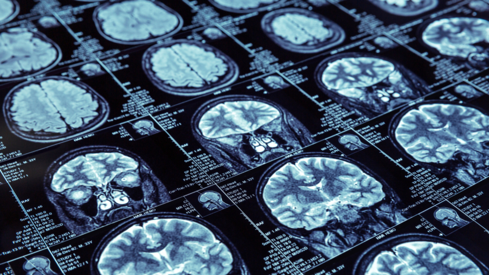 Demans ve ALS hastaları için umut veren gelişme