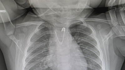 10 aylık bebek çengelli iğne yuttu!