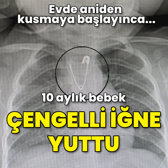 10 aylık bebek çengelli iğne yuttu!