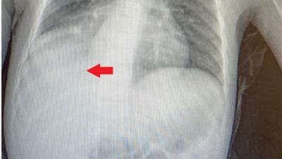 Doktorları bile şaşırttı! 3 yıl çekirdekle yaşadı