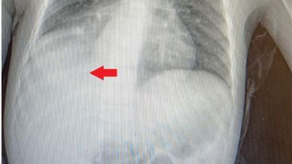 Doktorları bile şaşırttı! 3 yıl çekirdekle yaşadı