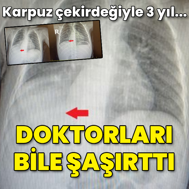 Doktorları bile şaşırttı! 3 yıl çekirdekle yaşadı