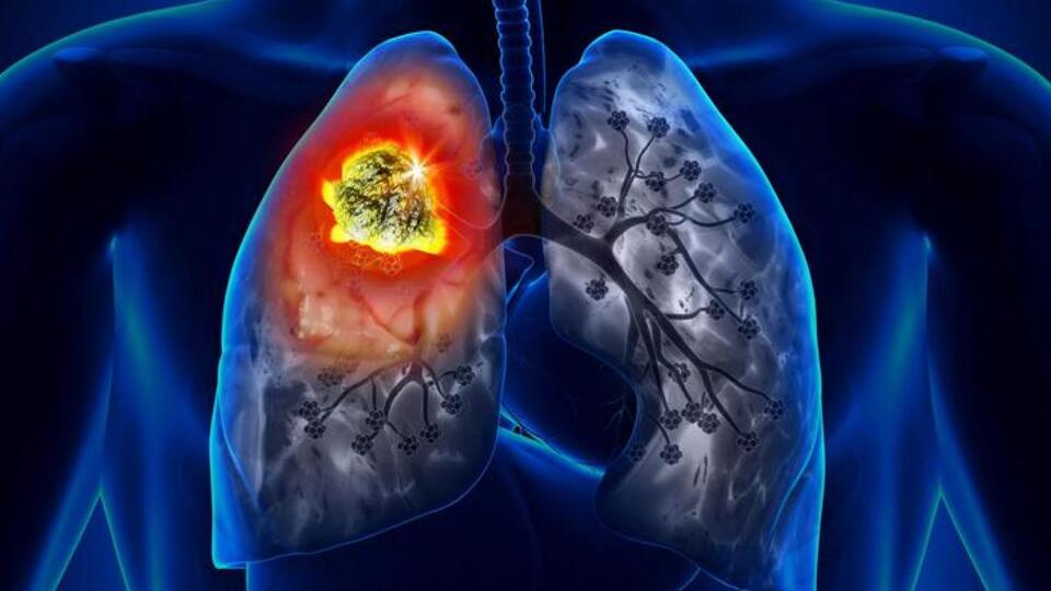 Kanser sanıldı, acı biber parçası çıktı