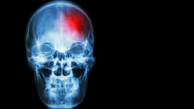 Sıcak hava, beyin kanaması riskini artırıyor