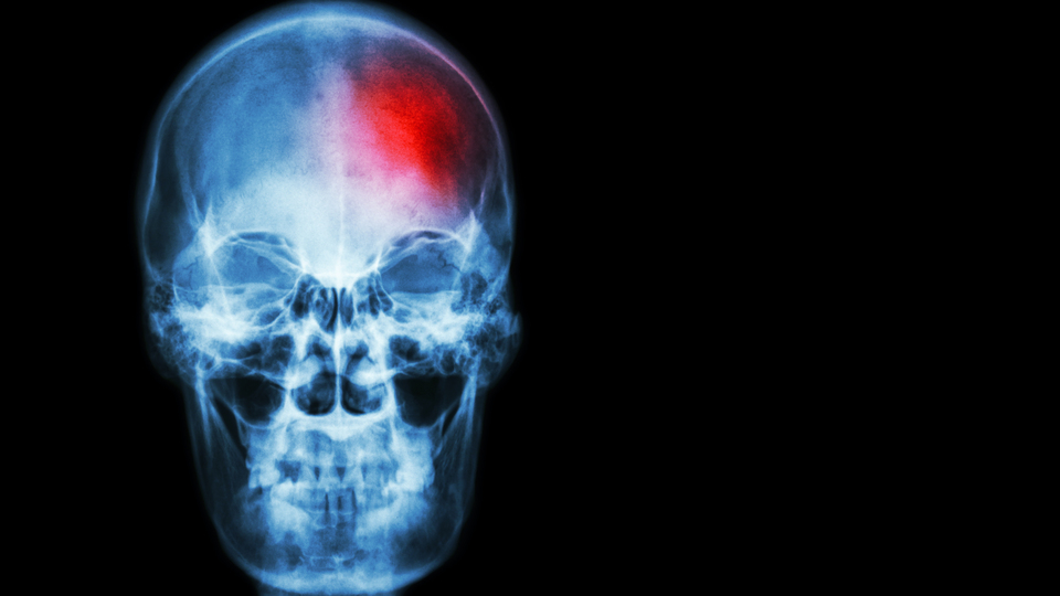 Sıcak hava, beyin kanaması riskini artırıyor