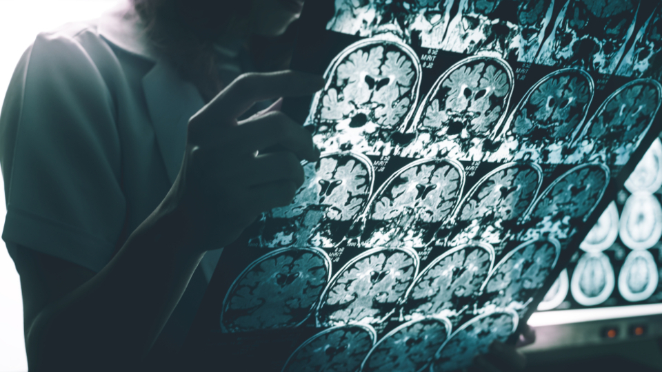 AB, "tarihi" Alzheimer ilacına ruhsat vermedi