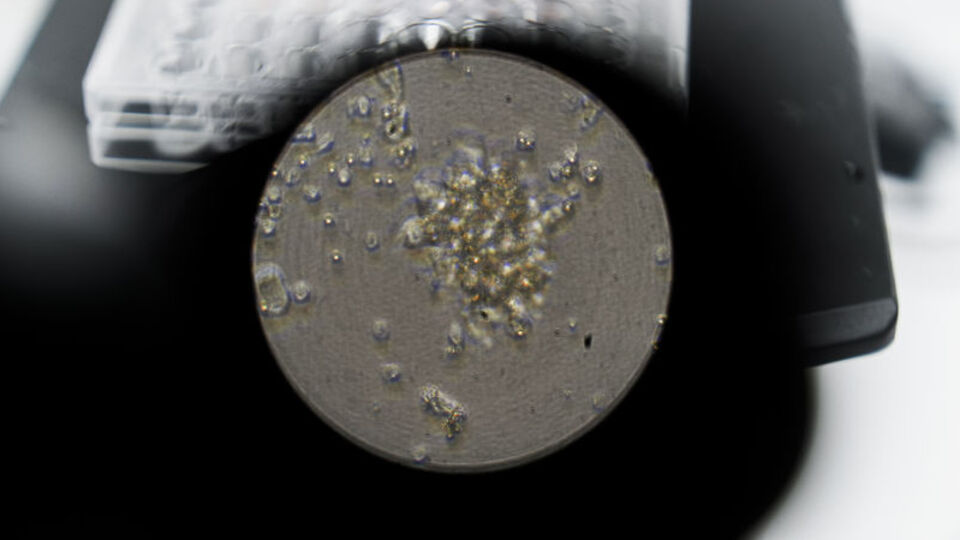 7 kardeşi ölmüştü! 6 yaşındaki Lara kurtuldu! Mucize doktora ödül