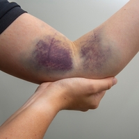 Yaralar iyileşirken neden renk değiştiriyor?