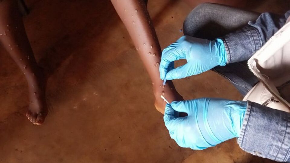 AB, M çiçeği için 215 bin doz aşı gönderecek