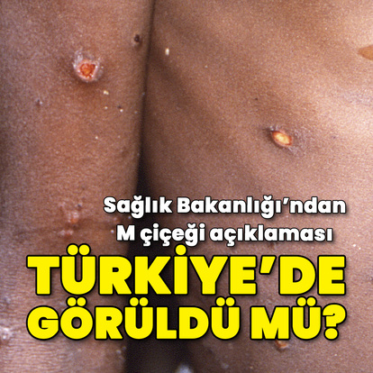 Sağlık Bakanlığı'ndan M Çiçeği açıklaması!