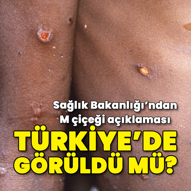 Sağlık Bakanlığı'ndan M Çiçeği açıklaması!