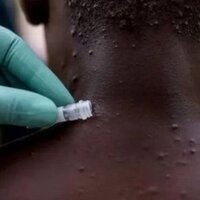 Türkiye'de maymun çiçeği hastalığı var mı?