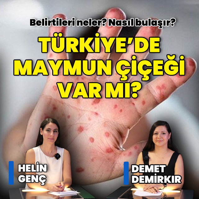 Maymun Çiçeği virüsü nasıl bulaşır? Hastalığın belirtileri neler?