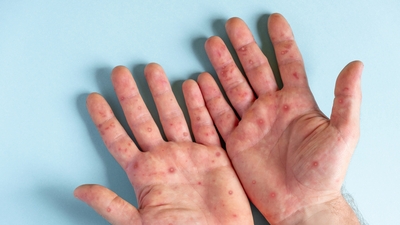 Sağlık Bakanlığı "M çiçeği" rehberini güncelledi