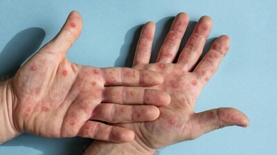 M çiçeğinden nasıl korunuruz?