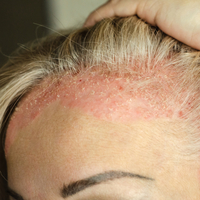 7 farklı egzama türü hangileri?