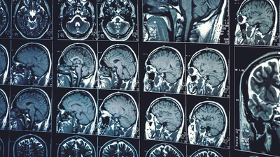 Covid-19 sürecindeki sokağa çıkma yasakları genç kızların beyinlerini daha fazla yaşlandırmış