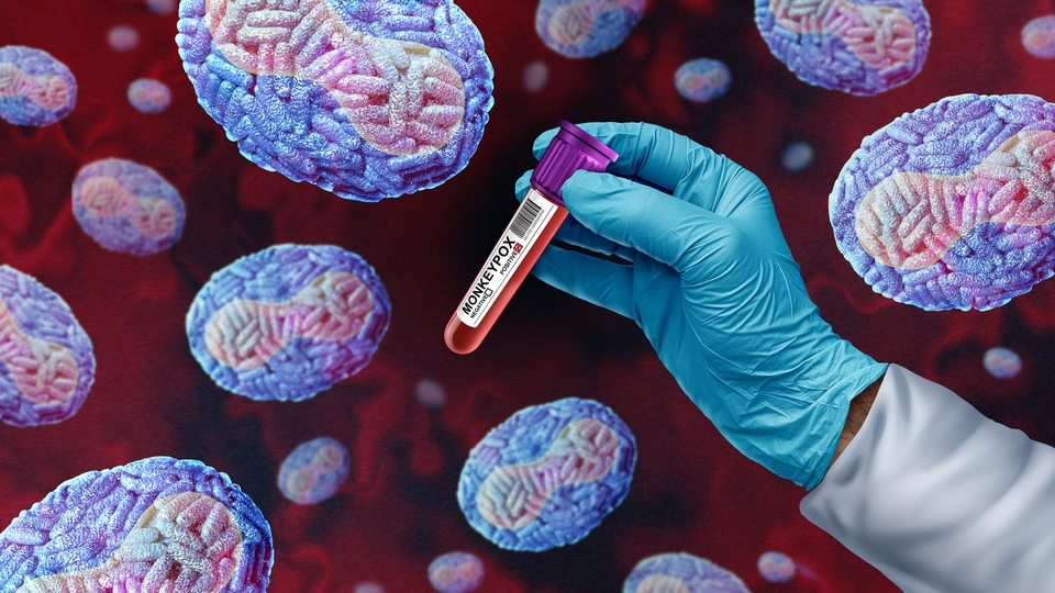 M çiçeği virüsü İstanbul'da görüldü mü? İstanbul İl Sağlık Müdürlüğü'nden açıklama