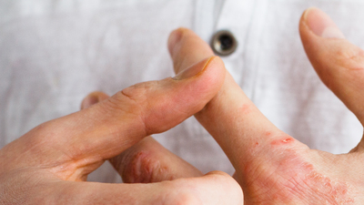 Egzama tedavisinin ardından geceleri rahat uyumaya başladı