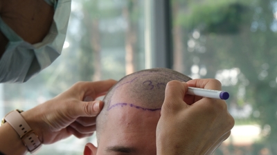 Dünyada az sayıda cerrah kullanıyor! Saç ekiminde tara ve çık