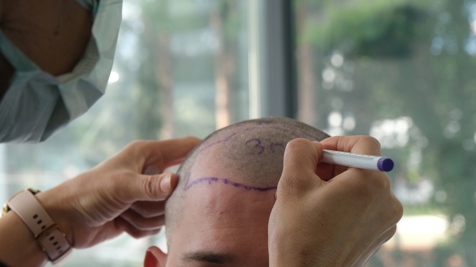 Dünyada az sayıda cerrah kullanıyor! Saç ekiminde tara ve çık