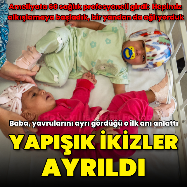 Pakistanlı yapışık ikizler Türkiye'de ayrıldı