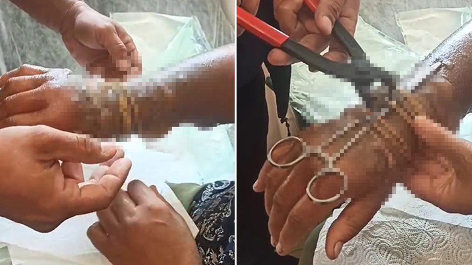 Kolu yanan kadının bilezikleri kesilerek çıkartıldı