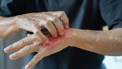 "Uyuz vakalarının sayısı her geçen gün artıyor"