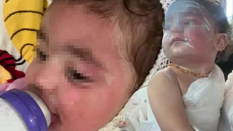Kreşte 1,5 yaşındaki çocuk kahve ile yandı!