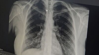 Prof. Dr. Özlü'den 'akut bronşit' uyarısı!