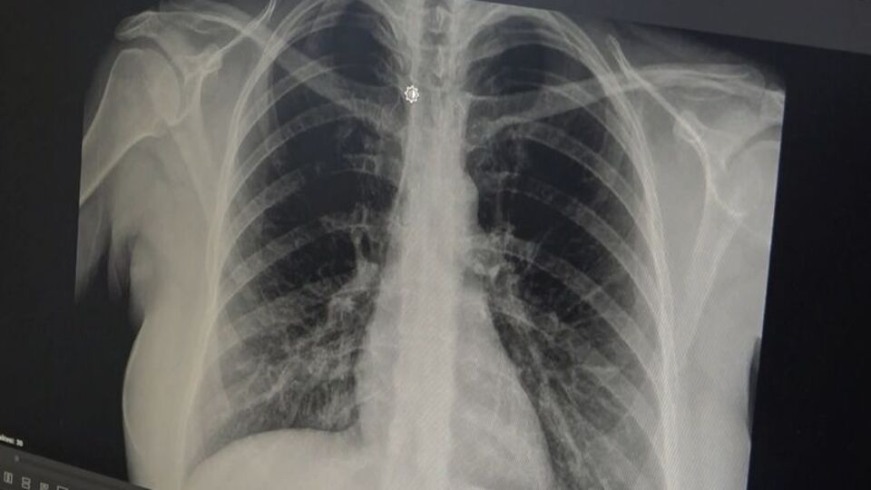 Prof. Dr. Özlü'den 'akut bronşit' uyarısı!