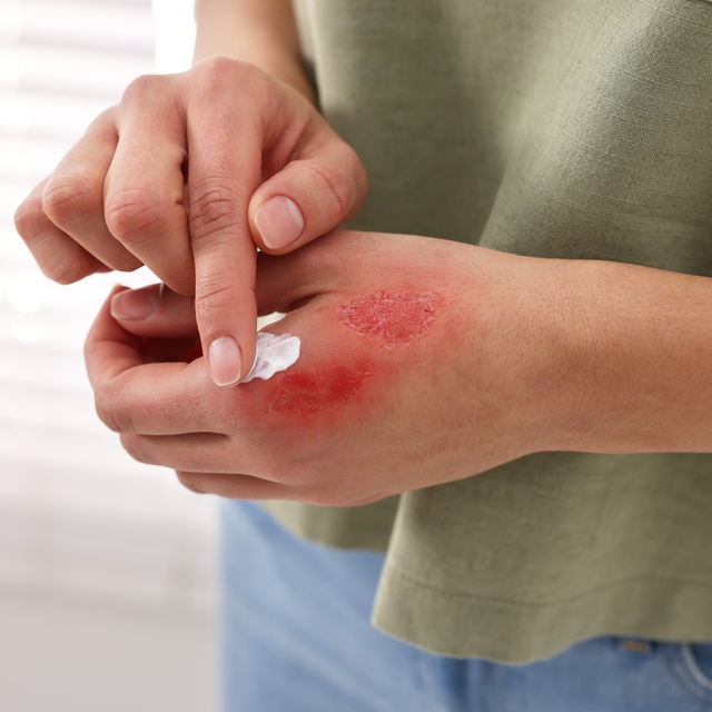  "Yanığın üzerine yağ, diş macunu, zeytin sürmeyin" uyarısı