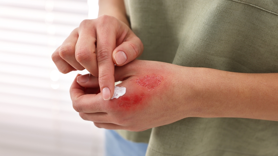 "Yanığın üzerine yağ, diş macunu, zeytin sürmeyin" uyarısı