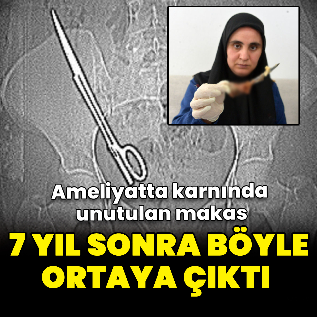  Ameliyatta karnında unutulan makas, 7 yıl sonra baş ağrısıyla ortaya çıktı